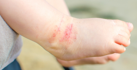 AAP atualiza recomendações para o tratamento da dermatite atópica em crianças