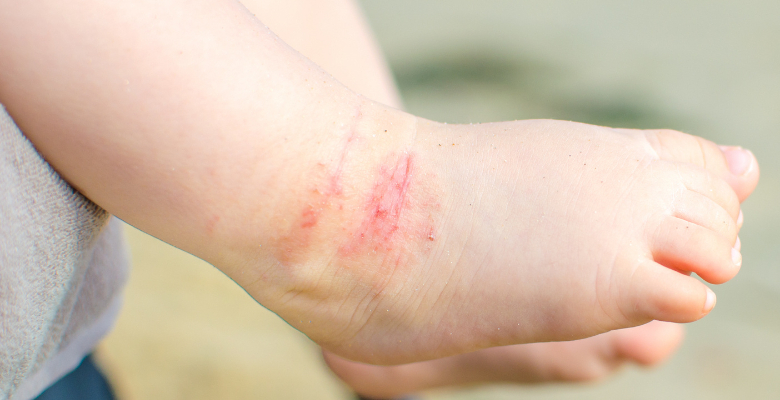 Estudo identifica palmas hiperlineares como marcador precoce de risco de DA em bebés